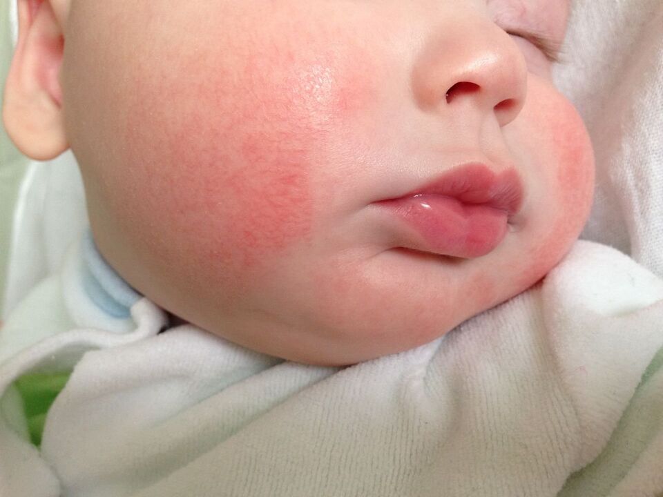 A sign of worms in a child is allergic urticaria. 